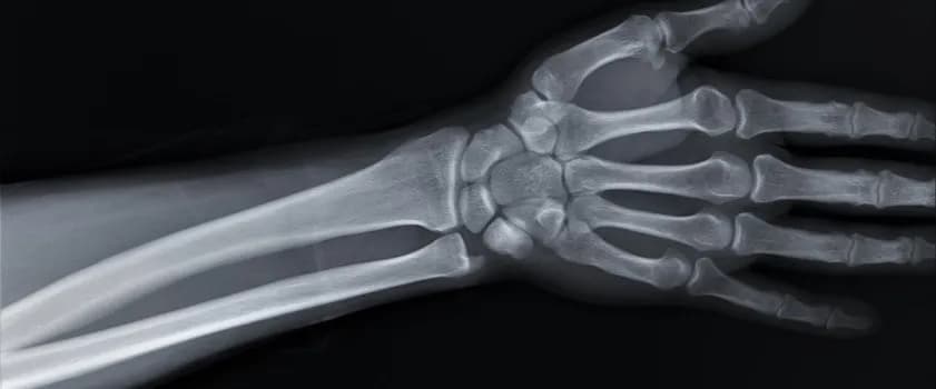 Czy złamana ręka puchnie? Objawy, leczenie i rehabilitacja