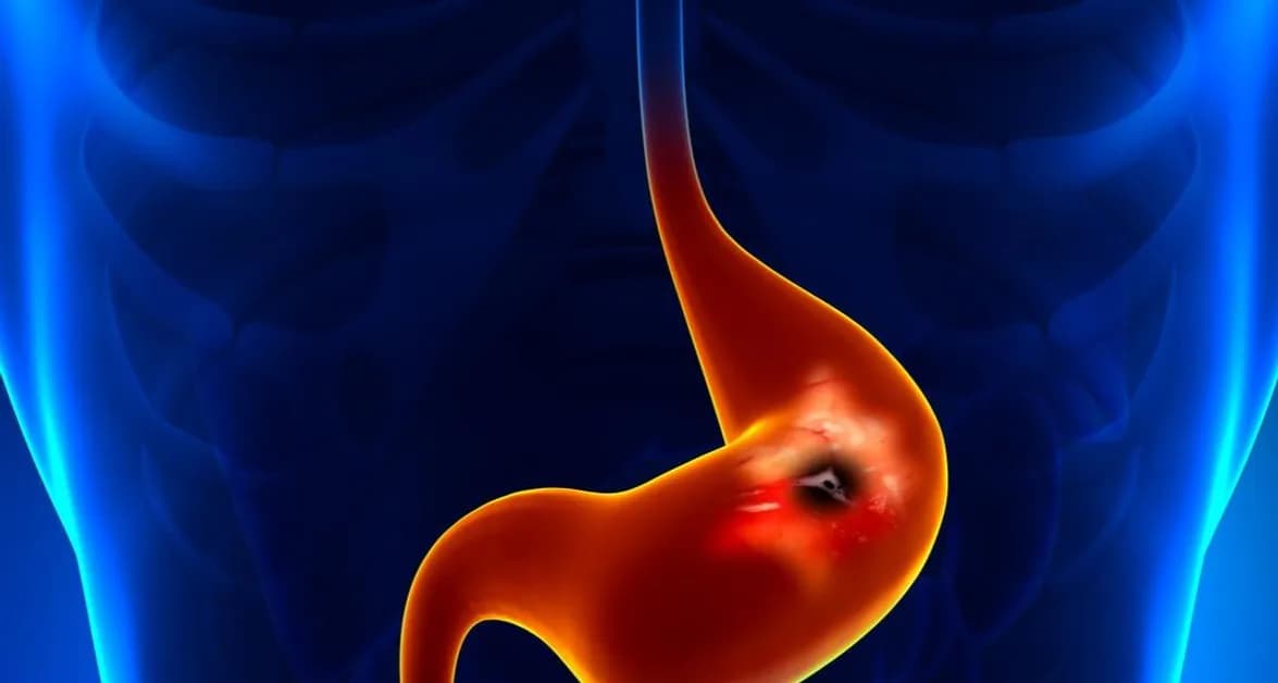 Skutki uboczne metronidazolu – co powinieneś wiedzieć, by się ochronić