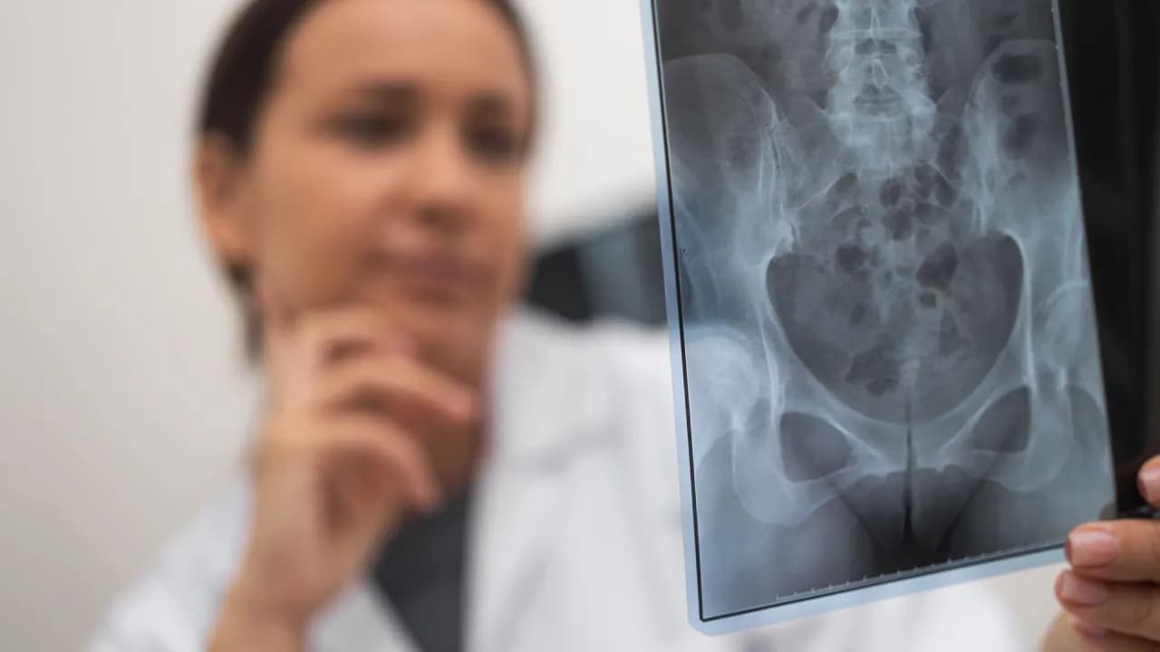 Złamane biodro: 5 kluczowych objawów, które musisz znać