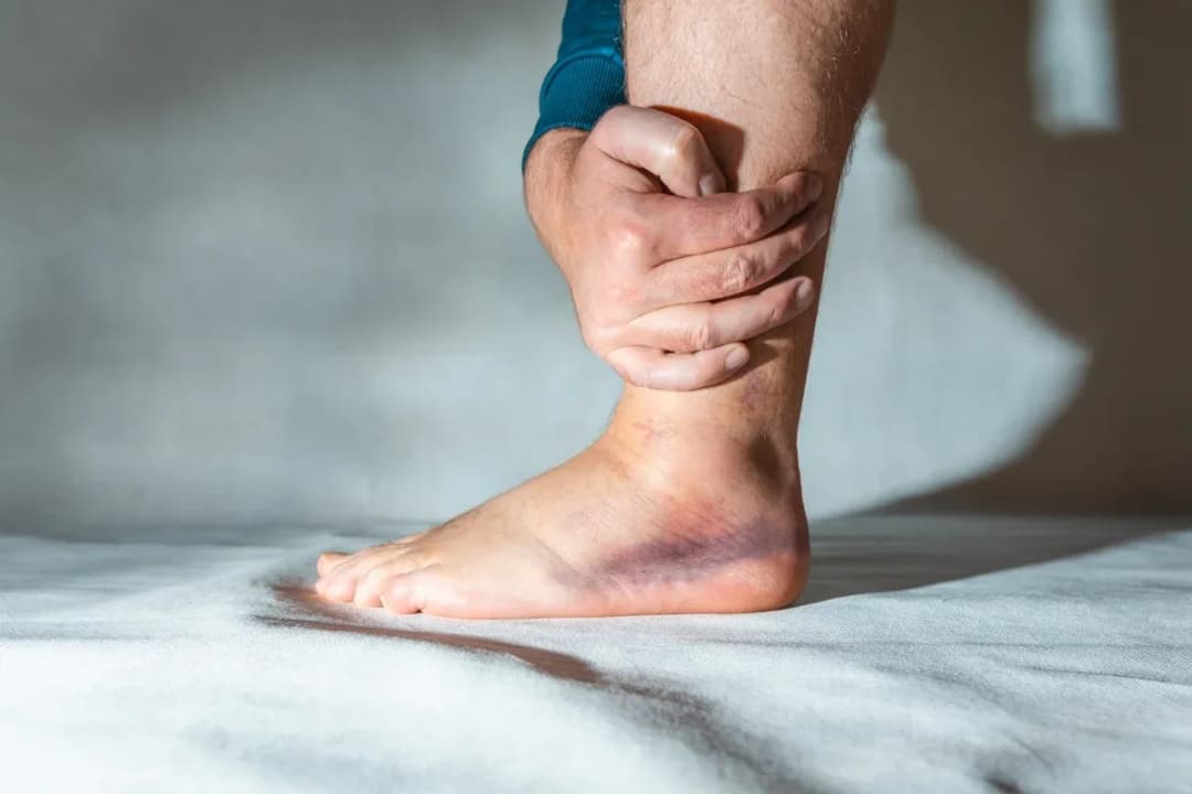 Zerwanie ATFL: Skuteczne metody leczenia i rehabilitacji