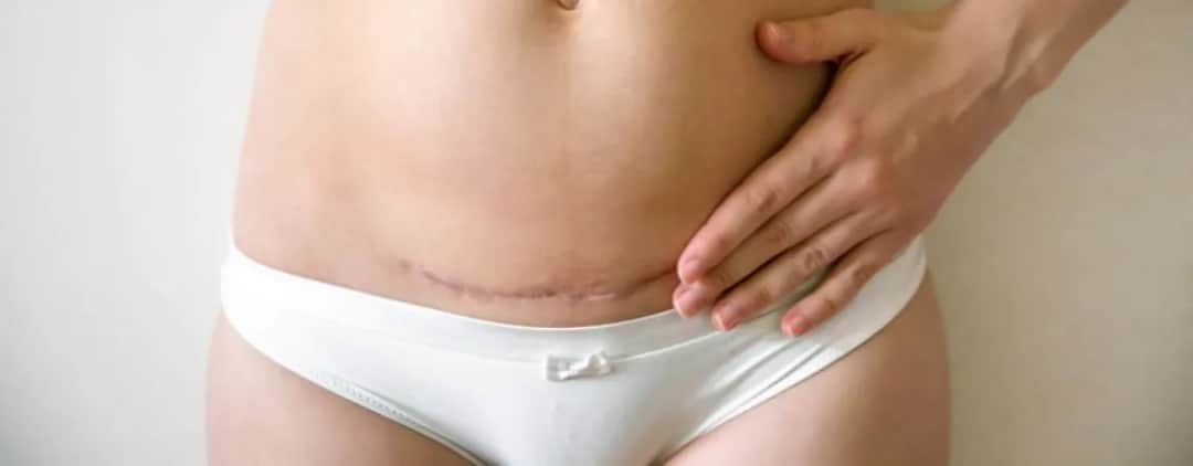 Skutki uboczne cesarki, które mogą zaskoczyć i wpłynąć na zdrowie mam.