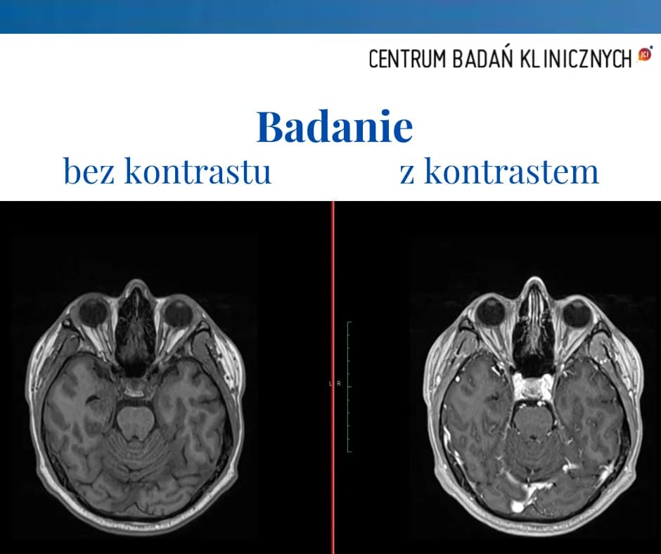 Skutki uboczne po podaniu kontrastu tomografii - co warto wiedzieć?