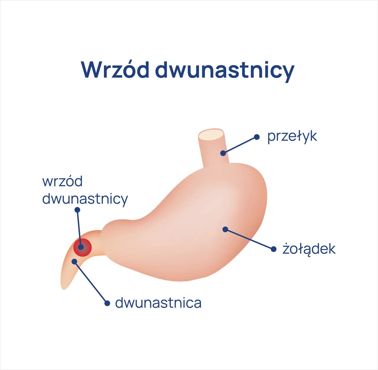 Ból dwunastnicy - objawy, które powinieneś znać. Diagnostyka
