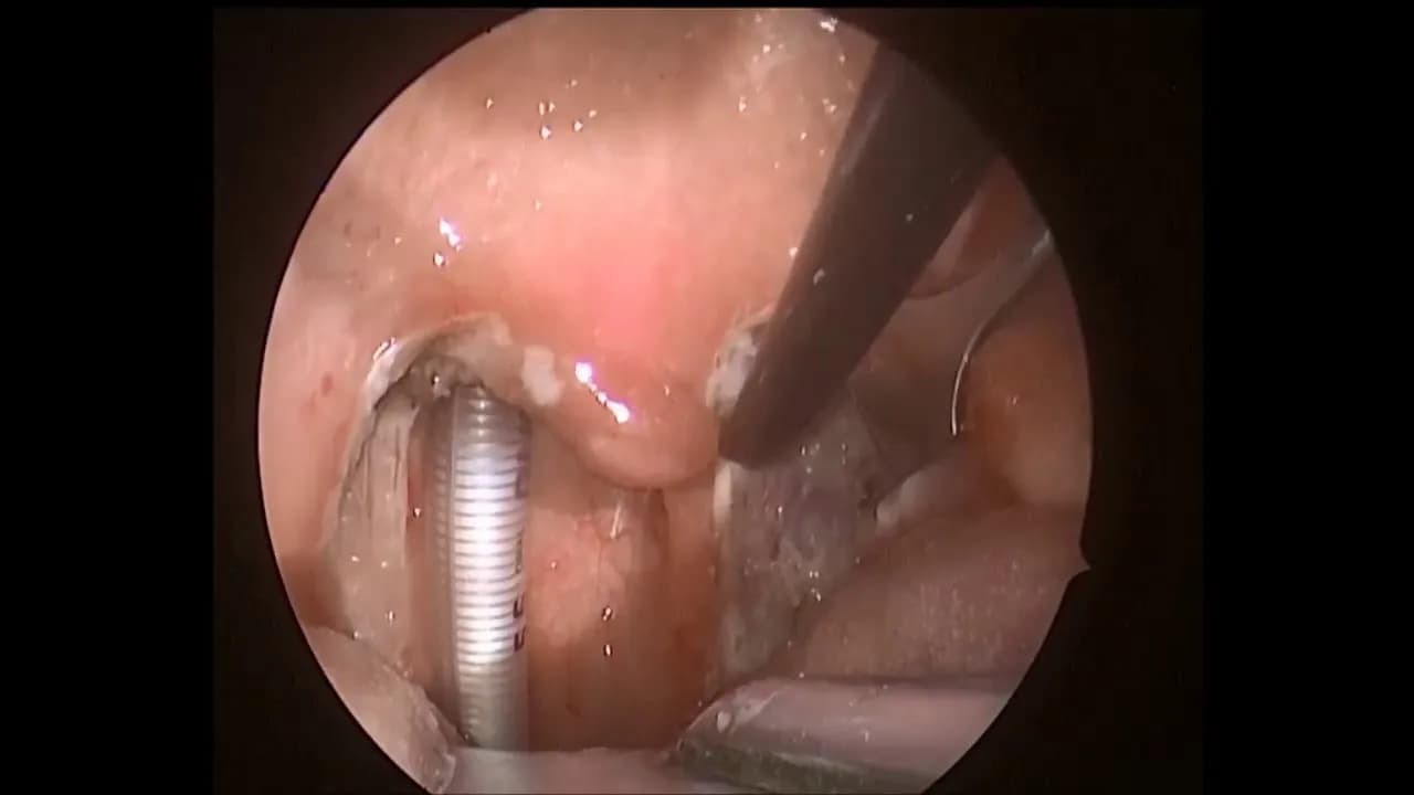 Skutki uboczne wycięcia migdałków: co musisz wiedzieć o ryzykach.