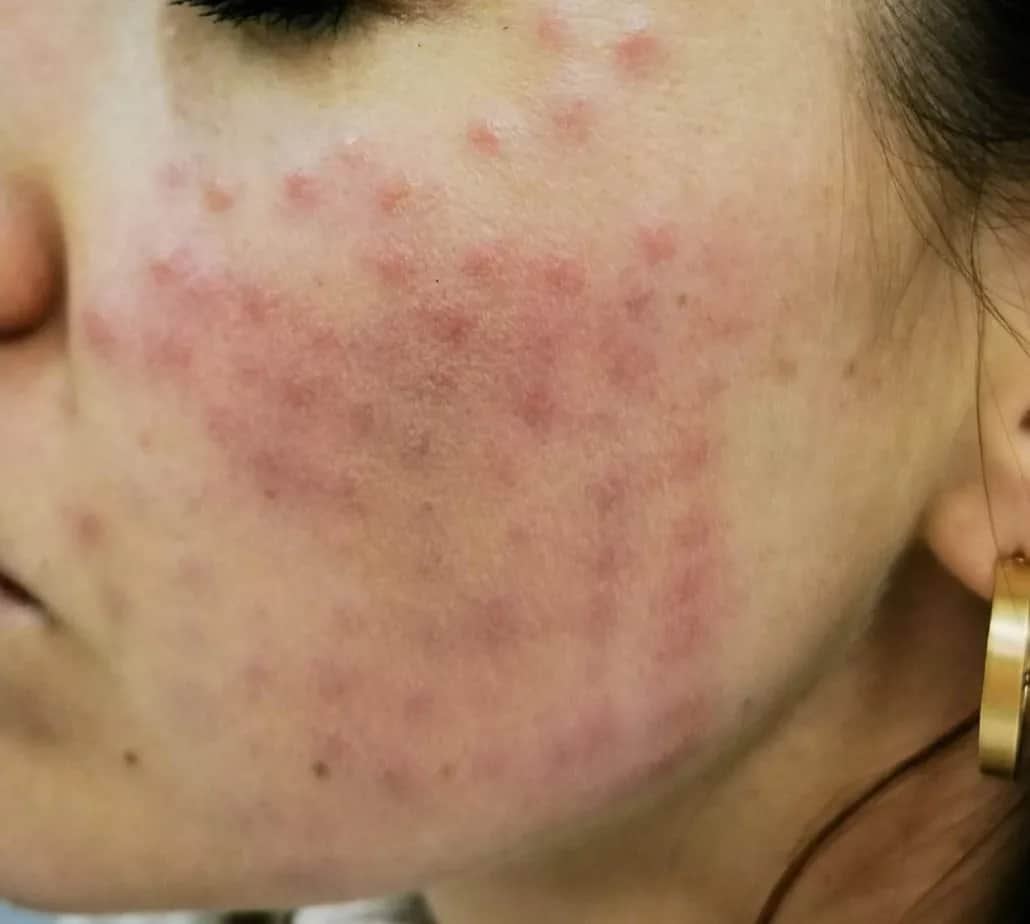 Skutki uboczne mezoterapii mikroigłowej: jakie ryzyka są realne?