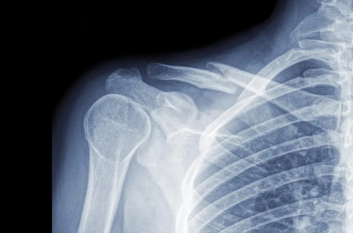 Złamany obojczyk u dziecka: objawy, diagnoza i leczenie