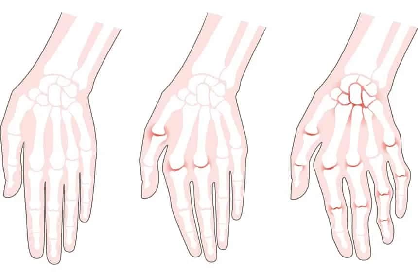 Wczesne objawy reumatoidalnego zapalenia stawów - rozpoznaj RZS