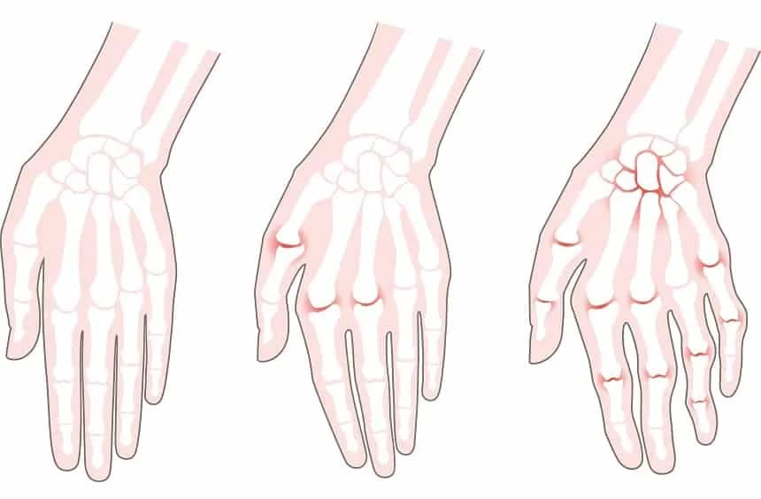 Wczesne objawy reumatoidalnego zapalenia stawów - rozpoznaj RZS