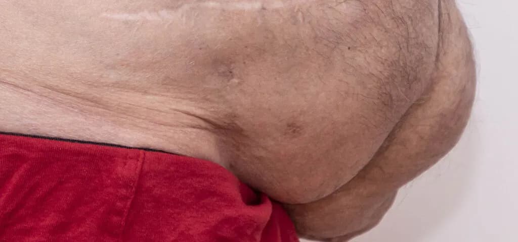 Przepuklina brzuszna u dorosłych - 7 niepokojących objawów