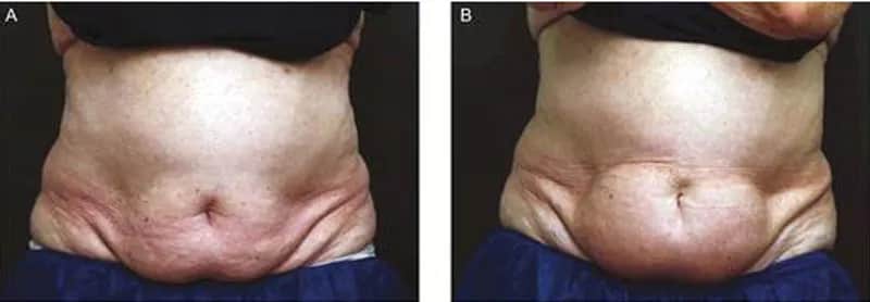 Skutki uboczne kriolipolizy: co warto wiedzieć przed zabiegiem?