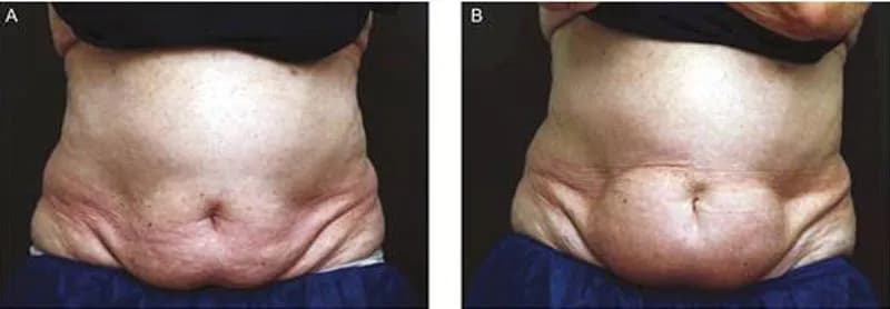 Skutki uboczne kriolipolizy: co warto wiedzieć przed zabiegiem?