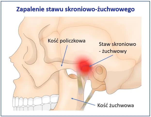 Zapalenie stawu szczękowego: 7 objawów, które musisz znać