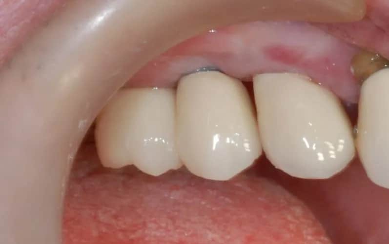 Skutki uboczne implantów z tytanu: jakie powikłania mogą cię zaskoczyć?