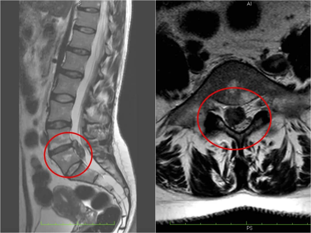 Wypuklina a przepuklina: kluczowe różnice i metody leczenia