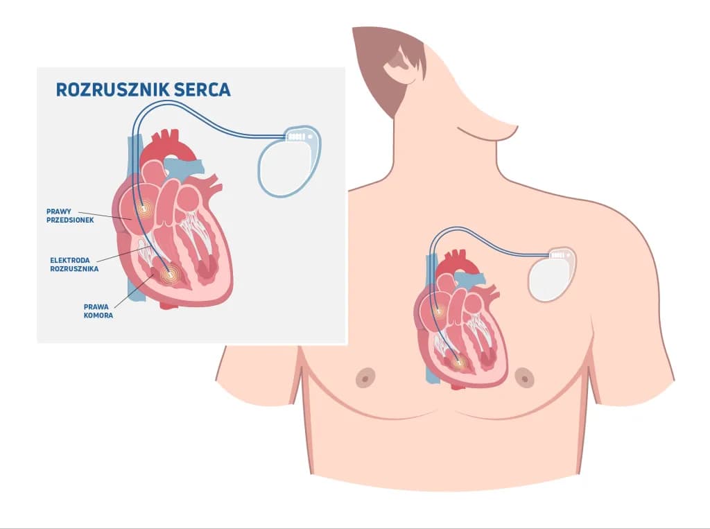Skutki uboczne po wszczepieniu rozrusznika serca – najważniejsze informacje i objawy.