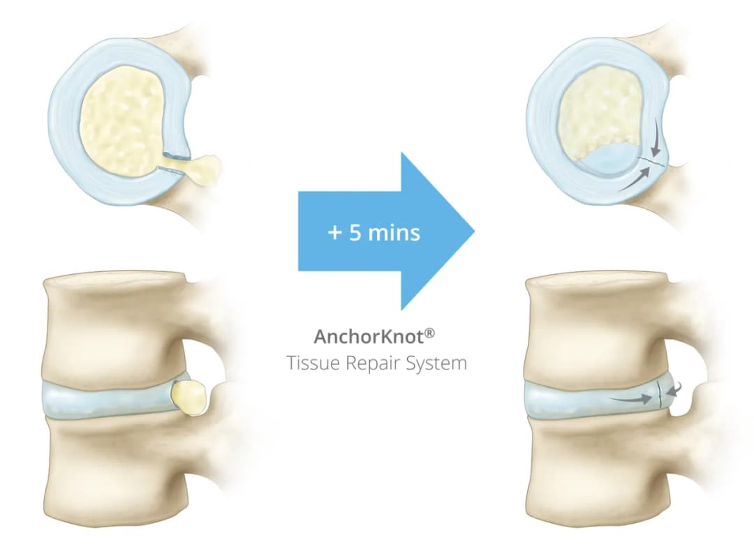Skuteczne metody leczenia uszkodzenia pierścienia włóknistego