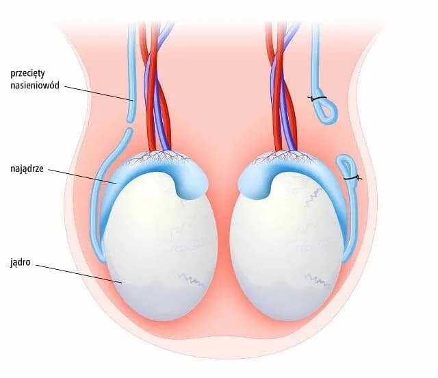 Skutki uboczne wazektomii: co musisz wiedzieć przed zabiegiem