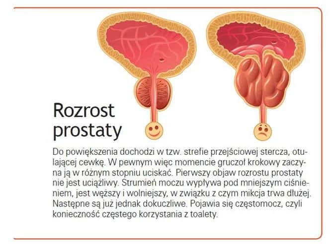 Skutki uboczne leków na prostatę: jak unikać zagrożeń i monitorować zdrowie