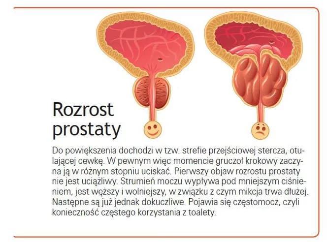 Skutki uboczne leków na prostatę: jak unikać zagrożeń i monitorować zdrowie