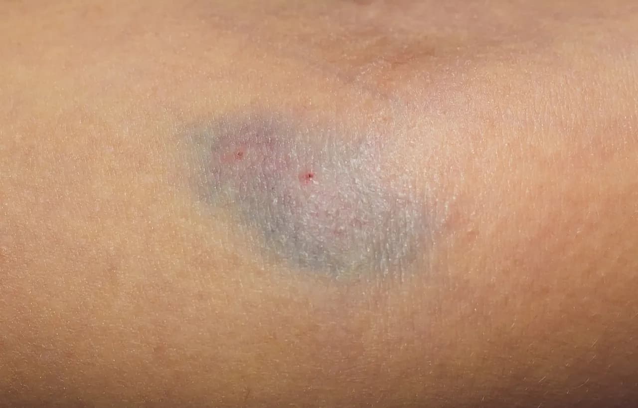 Skutki uboczne po wenflonie – poznaj poważne komplikacje i objawy