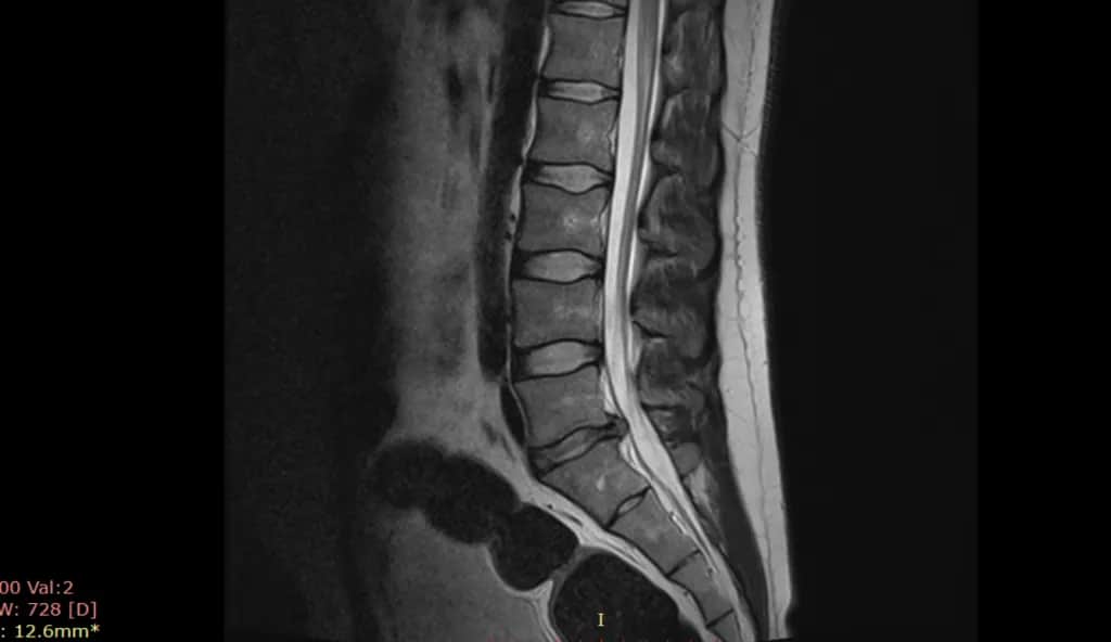 Czy przepuklina kręgosłupa może się cofnąć? Fakty i mity