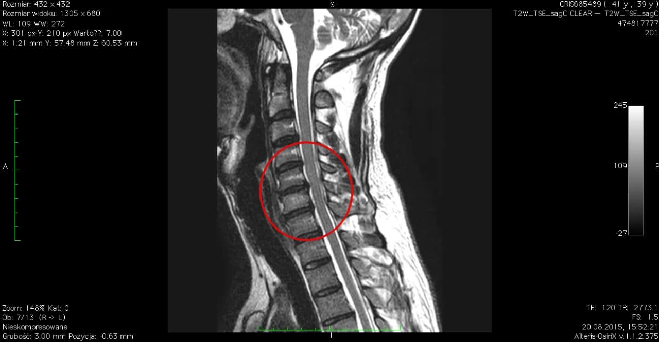Choroba krążka szyjnego z uszkodzeniem nerwów: objawy i leczenie