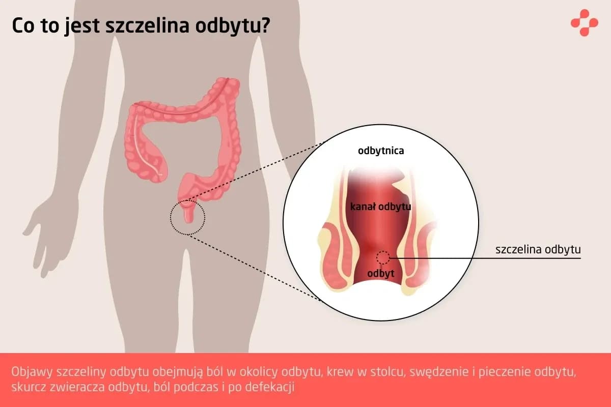 Zwieracze odbytu - objawy uszkodzenia, o których musisz wiedzieć