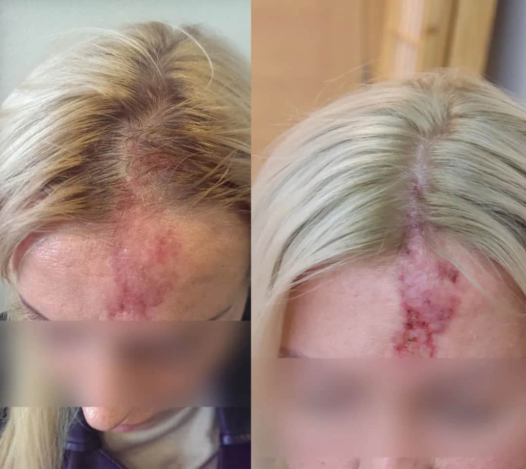 Skutki uboczne kwasu hialuronowego – co powinieneś wiedzieć przed zabiegiem?