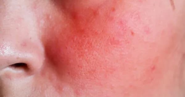 Skutki uboczne retinolu: jakie ryzyka możesz napotkać na skórze?