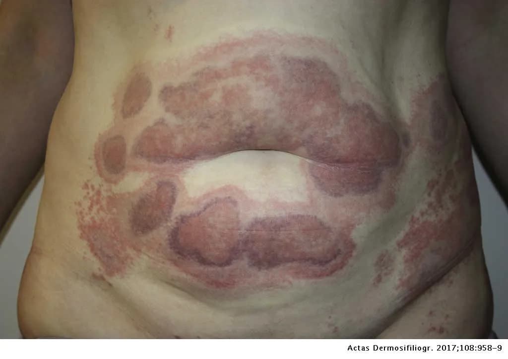 Skutki uboczne lipolizy: jak unikać poważnych zagrożeń i objawów