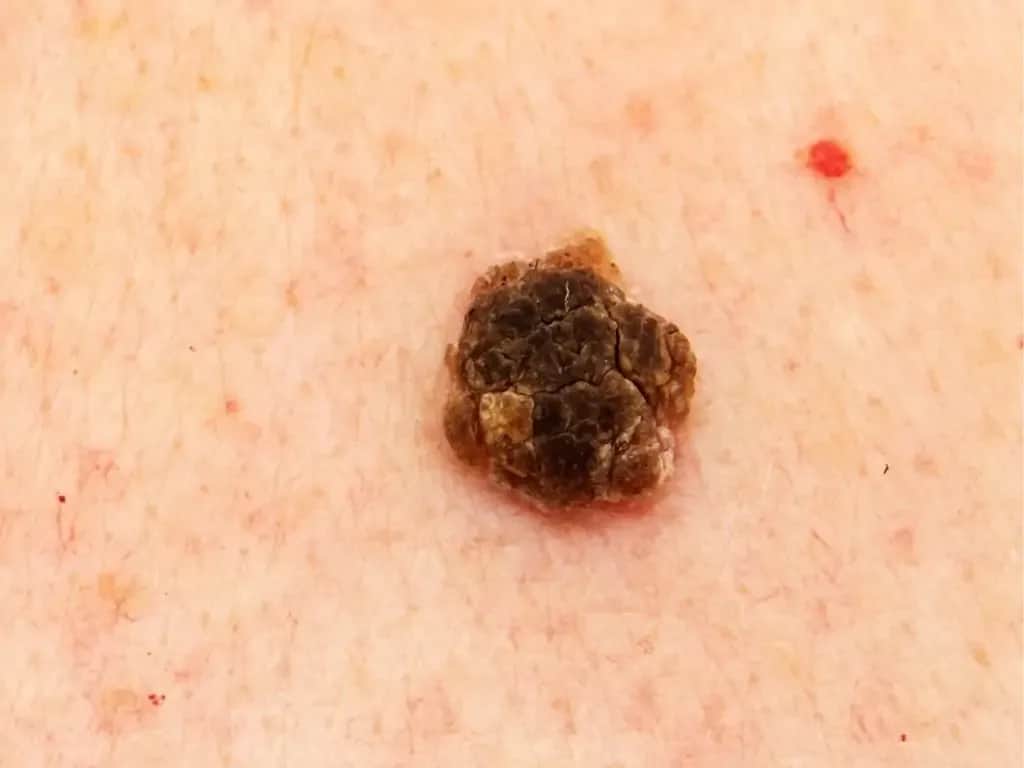 Brodawka łojotokowa - czy może odpaść? Fakty i mity